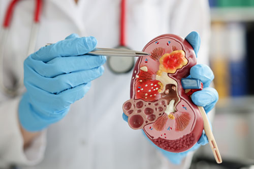 renal-cysts