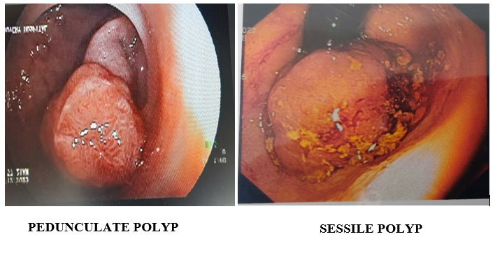 Rectal Polyp