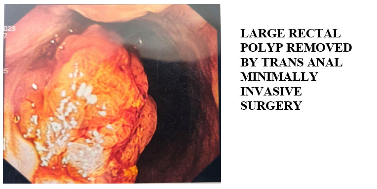 Rectal Polyp