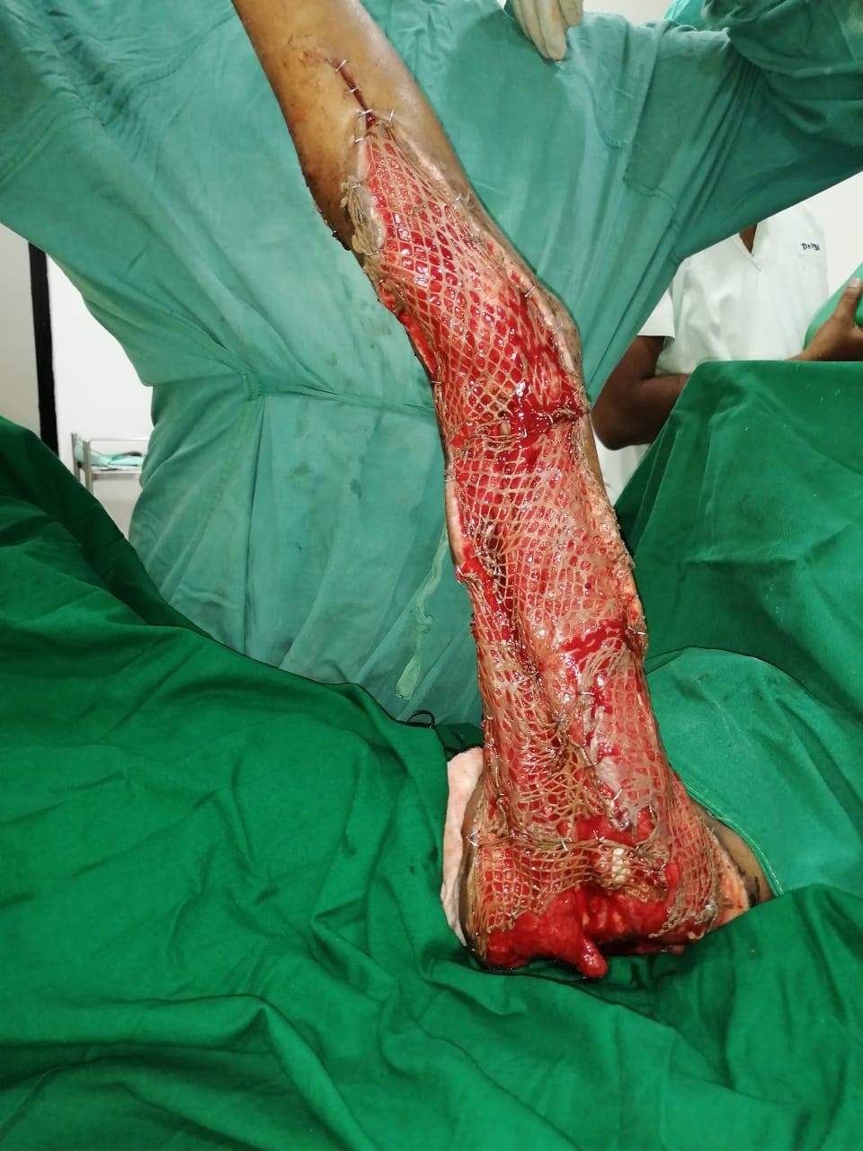 Successful-discharge-5