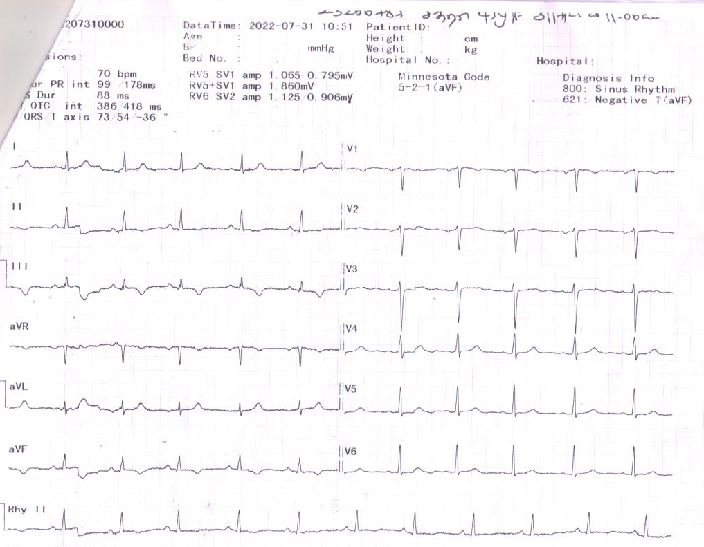 Dilated cardiomyopathy img2