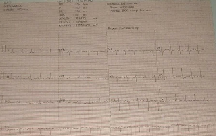 ECG-3