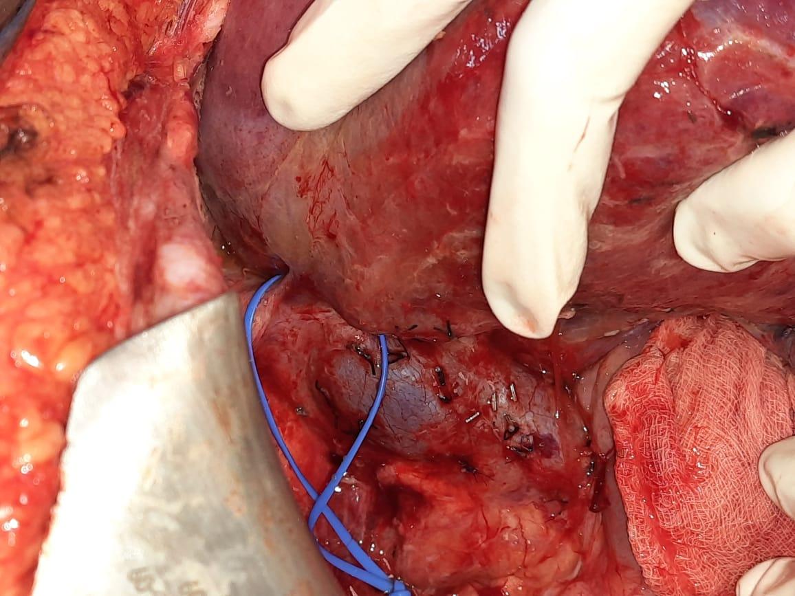 Liver-Resection