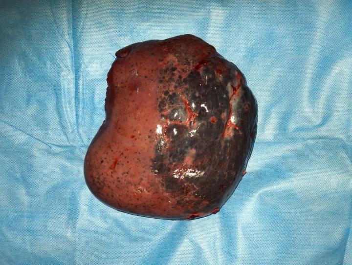 No-leak-propofol-cholangiogram