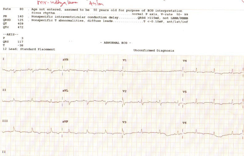 ecg