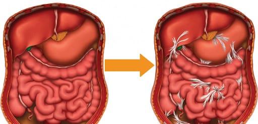 small-bowel-obstruction