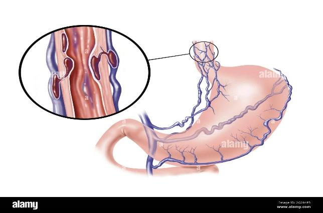 Esophageal-varices