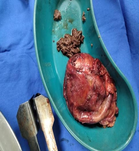 Mediastinal-mass