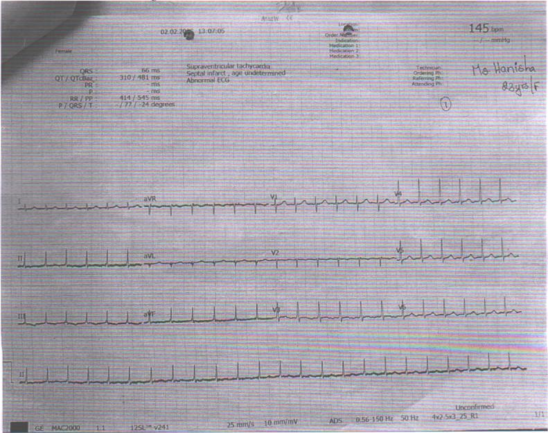 ECG2