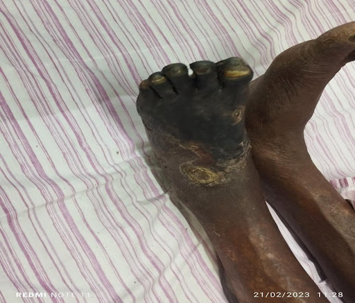 Gangrene