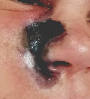 Mucormycosis-1