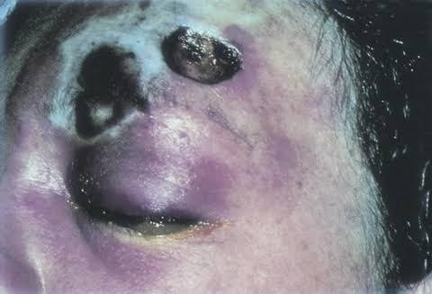 Mucormycosis-2