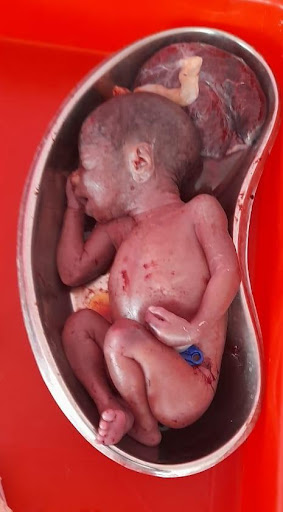 Spontaneous Abortion – 20 weeks with placenta