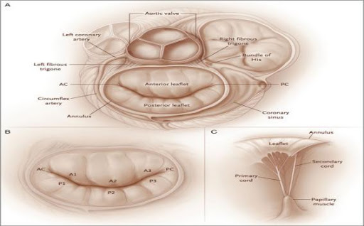 open-mitral-valve-replacement