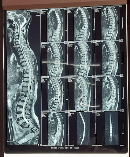 Fracture-L1-vertebra