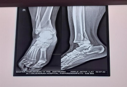 Malleolar-Fracture-Right-Ankle