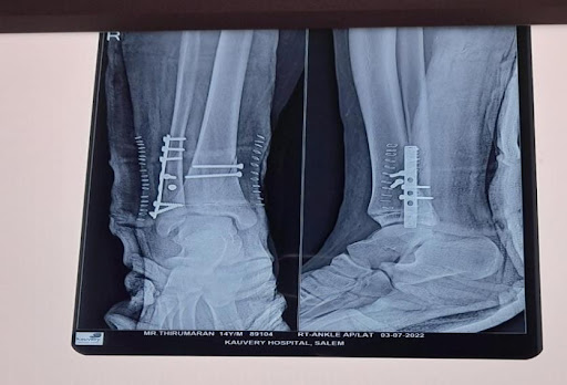 Right-Tibial-Screw-Fixation