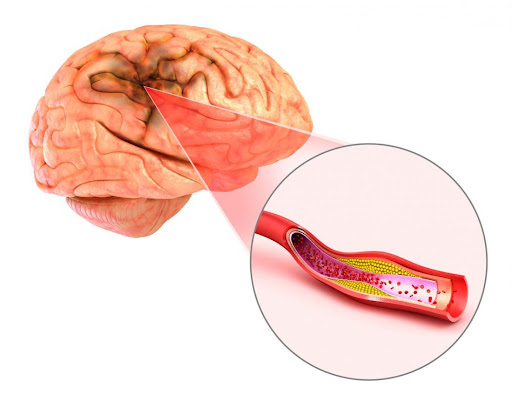 Cerebral-Aneurysm