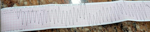 Coronary-Angiography-4