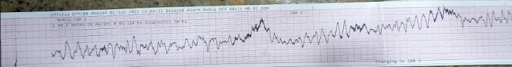 Coronary-Angiography-5