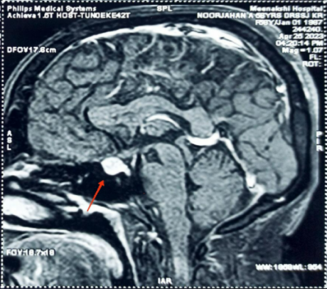 Pituitary-Macroadenom-1