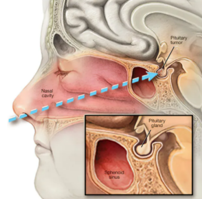 Pituitary-Macroadenom-2