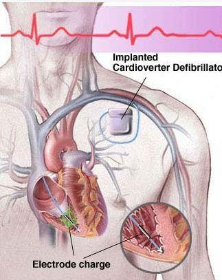 Implantable1