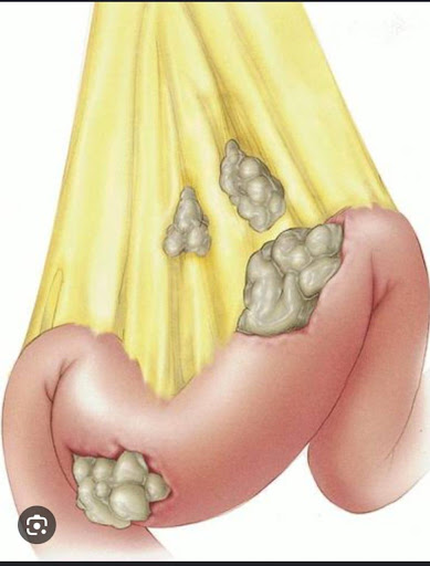 Mesentric-Neoplasm-1
