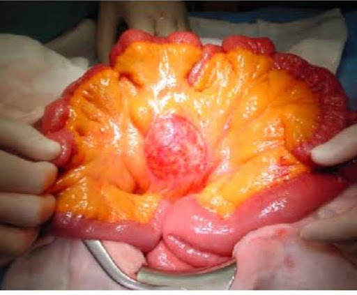 Mesentric-Neoplasm-2