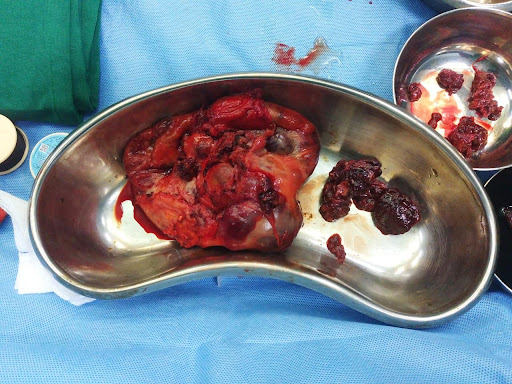 Mesentric-Neoplasm-3