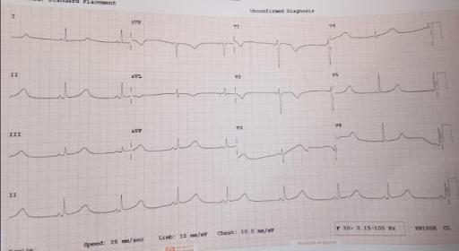QT-Syndrome-2
