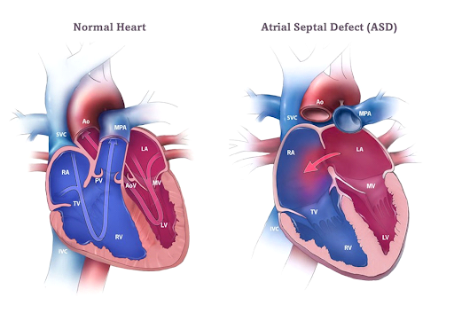 Congenital-heart-disease-1