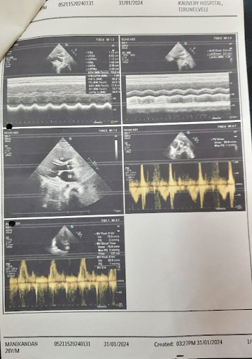 Congenital-heart-disease-10