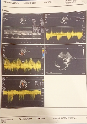 Congenital-heart-disease-4