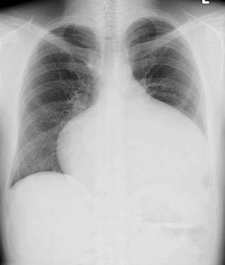 Congenital-heart-disease-6