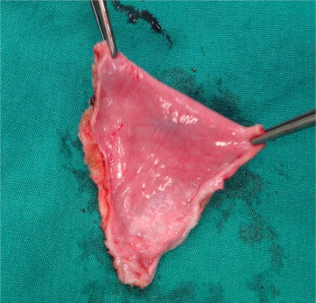Congenital-heart-disease-7