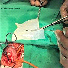 Congenital-heart-disease-8