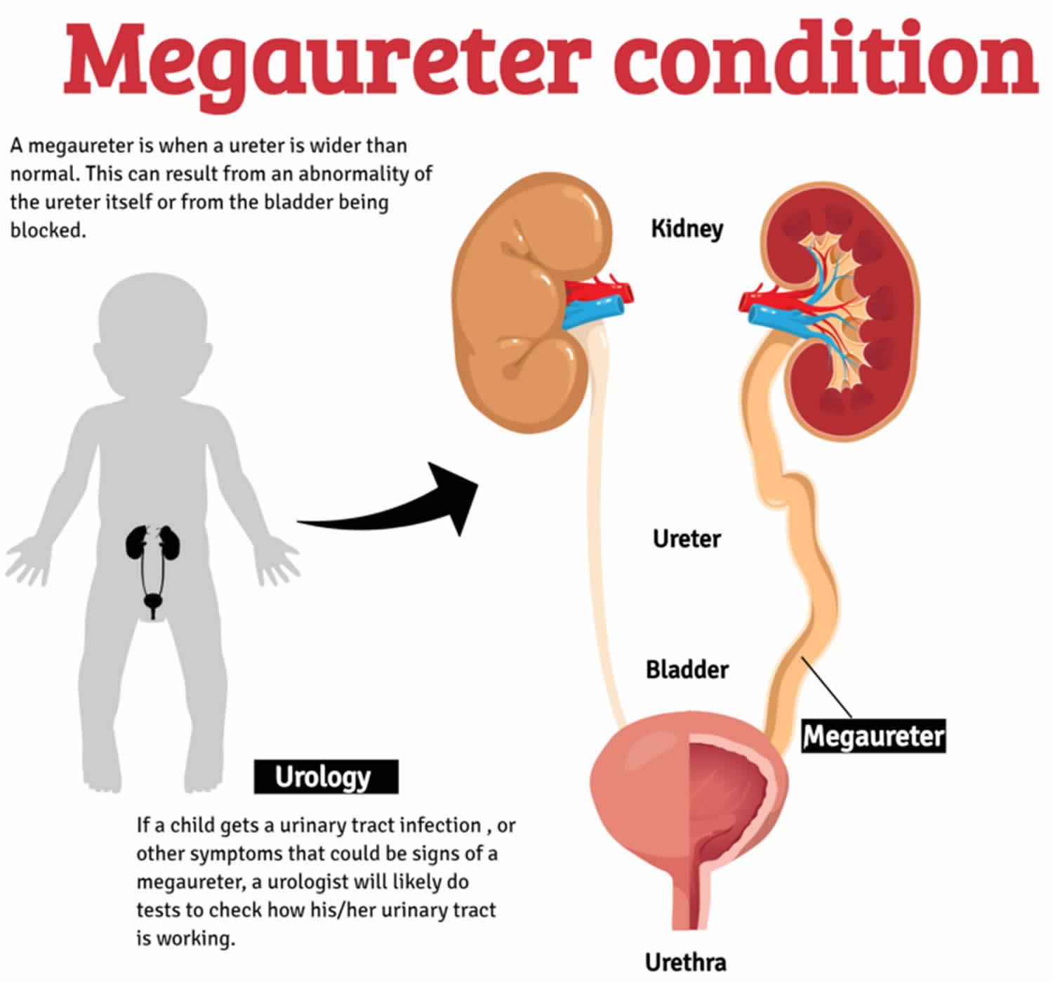 megaureter