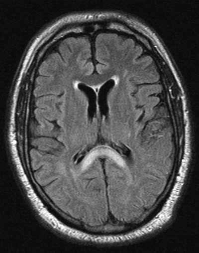 Dengue-presenting-as-Stroke2022-03-15-11:52:57am