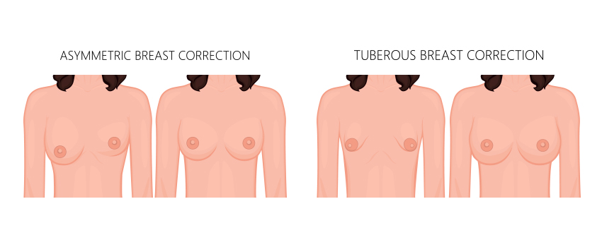 Surgical Correction of Asymmetrical and Accessory Breasts