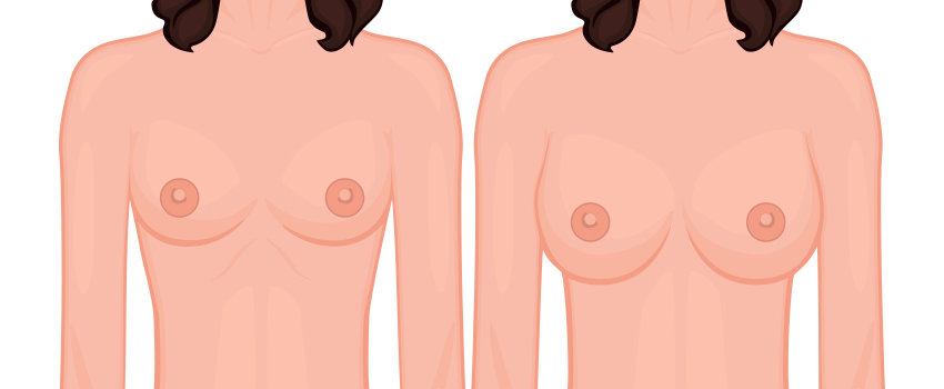 Breast Augmentation with Silicone or Saline Implants for Volume Enhancement