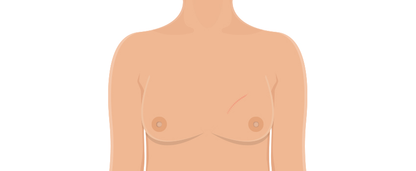 Breast Conserving Surgery for Tumour Removal with Natural Contour Preservation