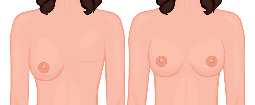 Breast Reconstruction Breast Reconstruction After Mastectomy Using Flap or Implant Techniques