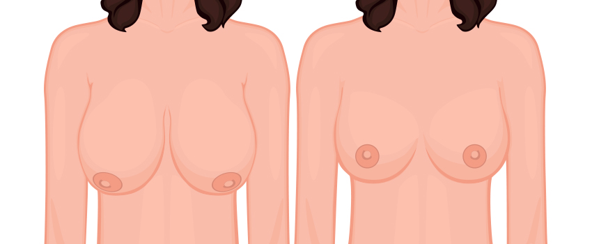 Breast Reduction & Breast Lift Surgery