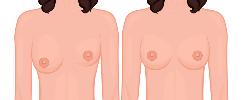 Revision Breast Surgery to Correct Asymmetry, Scarring, and Contour Issues