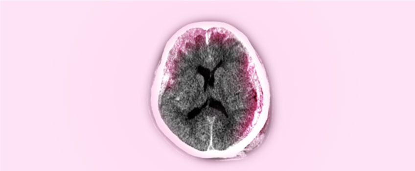 Epidural Hematoma