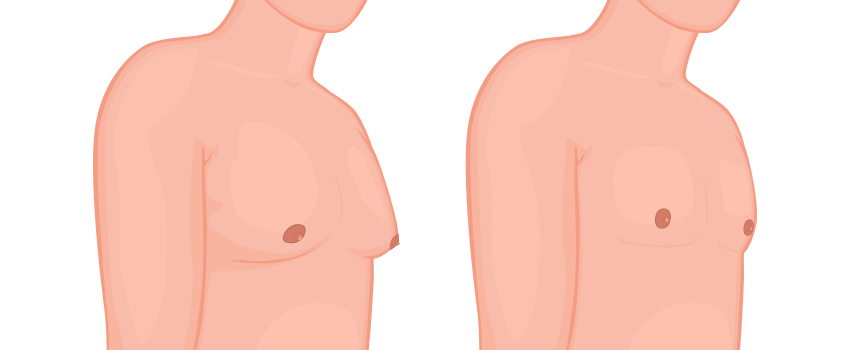 Cosmetic Surgery for Male Breast Contouring and Tissue Removal
