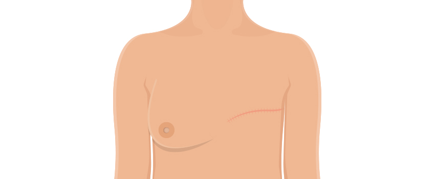 Mastectomy Procedure for Breast Cancer Treatment