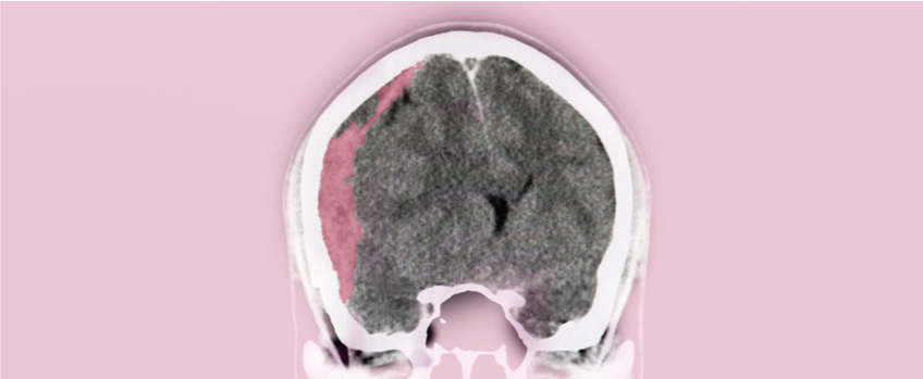 Acute Subdural Hematoma