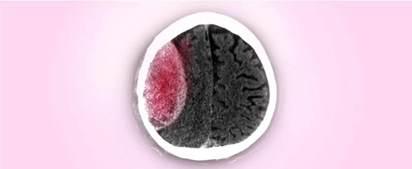 Chronic Subdural Hematoma